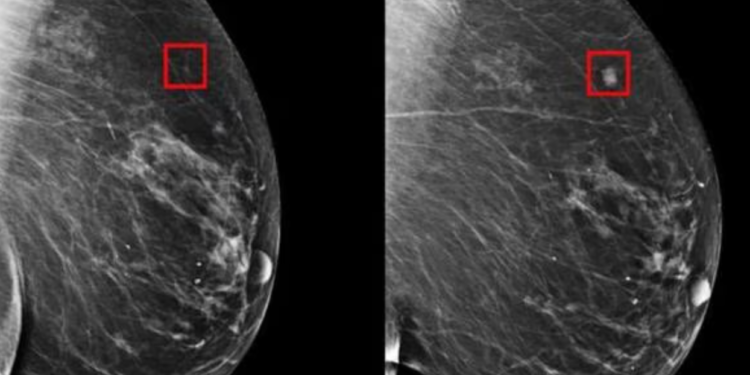 Inteligencia artificial sería capaz de detectar el cáncer de mama 4 años antes de formarse